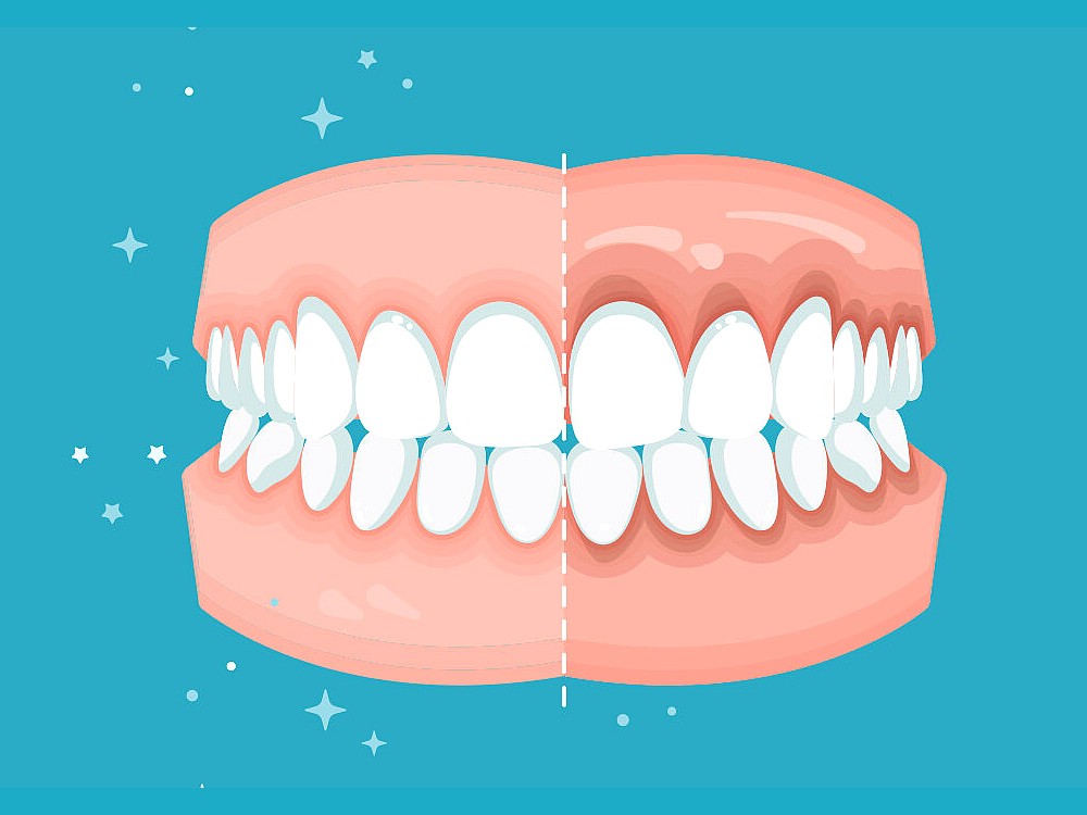 Diş Eti Çekilmesi Tedavisi Nasıl Yapılır? Nedenleri Nelerdir?