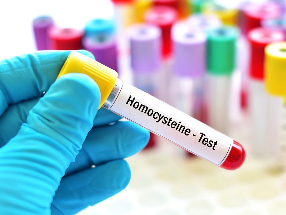 Homosistein Nedir? Yüksekliğinin Nedenleri Nelerdir? Belirtileri ve Tedavisi