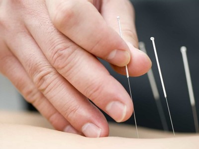 Akupunktur Zayıflatır mı? Akupunktur İle Zayıflama Yöntemi