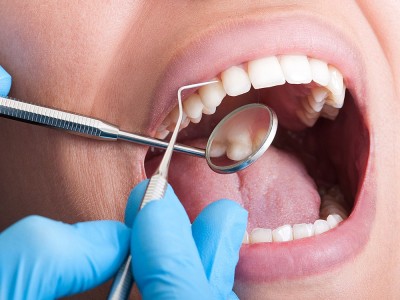 Diş Taşı Nedir? Nasıl Temizlenir? Neden Olur?
