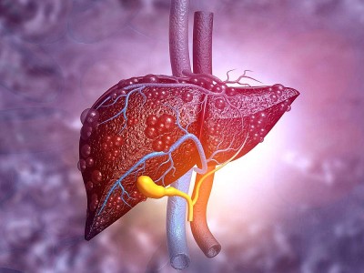 Karaciğer Yağlanması Nasıl Önlenir? Karaciğer Yağlanması Kürü Tarifi