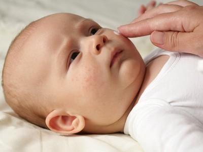 Yeni Doğan Bebek Aknesi Nedir? Nasıl Geçer?