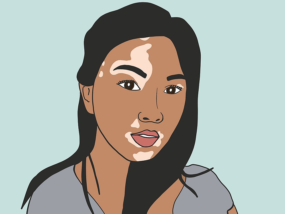 Vitiligo Hastalığı Nedir? Nasıl Geçer?
